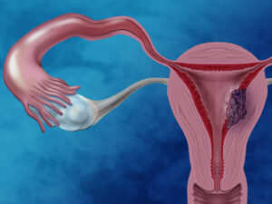 Cáncer de endometrio: el enemigo silencioso que afecta a miles de mujeres cada año