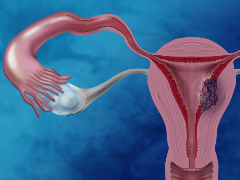 Cáncer de endometrio: el enemigo silencioso que afecta a miles de mujeres cada año