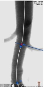 Aneurisma aórtico abdominal, amenaza silenciosa y desconocida potencialmente mortal
