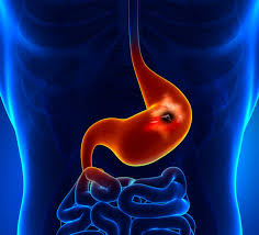 De lo invisible a lo urgente: la detección temprana del cáncer gástrico puede salvar vidas